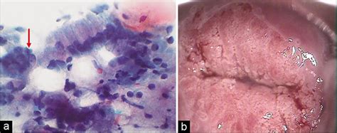 mild inflammation on pap smear|moderate acute inflammation pap smear.